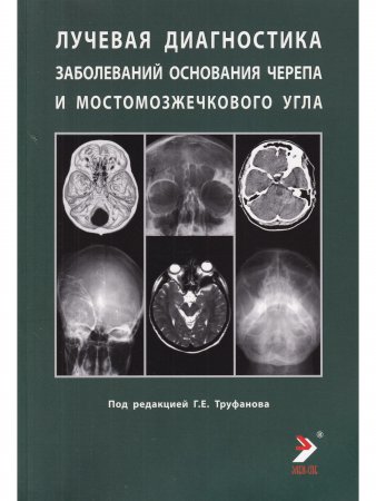 Лучевая диагностика оснований черепа и мостмозжечкового угла