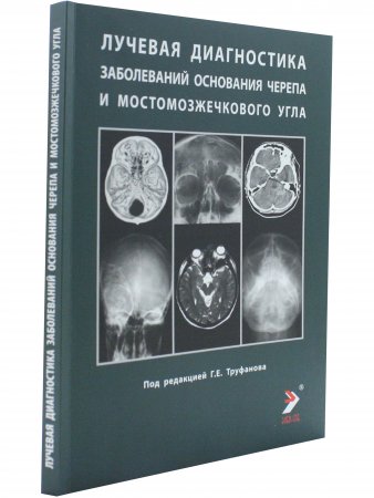 Лучевая диагностика оснований черепа и мостмозжечкового угла