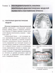 Анализ диагностических моделей челюстей