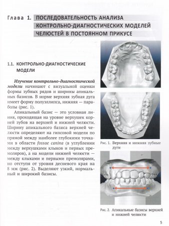 Анализ диагностических моделей челюстей