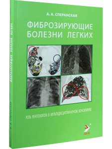 Фиброзирующие болезни легких. Роль рентгенолога в мультидисциплинарном консилиуме