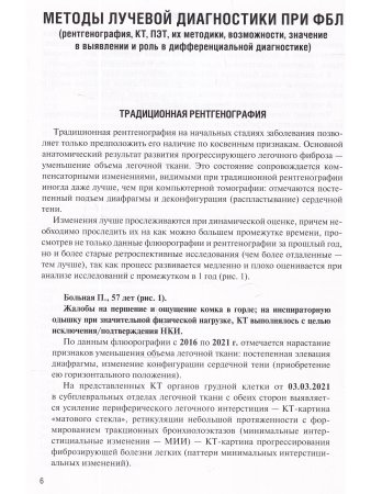 Фиброзирующие болезни легких. Роль рентгенолога в мультидисциплинарном консилиуме