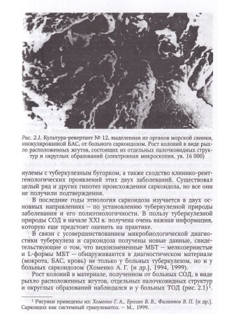 Саркоидоз в клинике туберкулеза органов дыхания